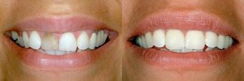 Smile Gallery - Oswego Dental, Oswego Dentist