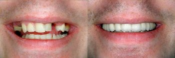 Smile Gallery - Oswego Dental, Oswego Dentist