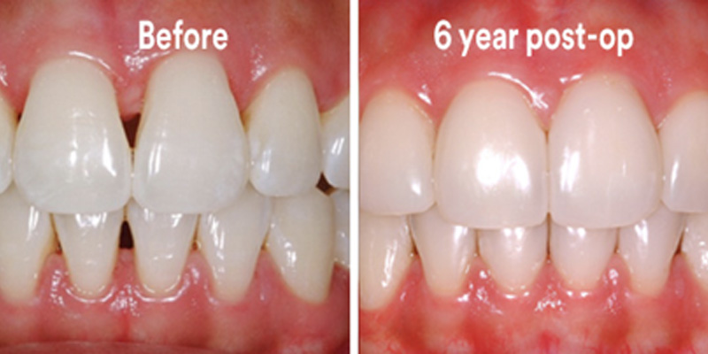 BioClear Diastema Closure and Black Triangle Closure  - Oswego Dental, Oswego Dentist