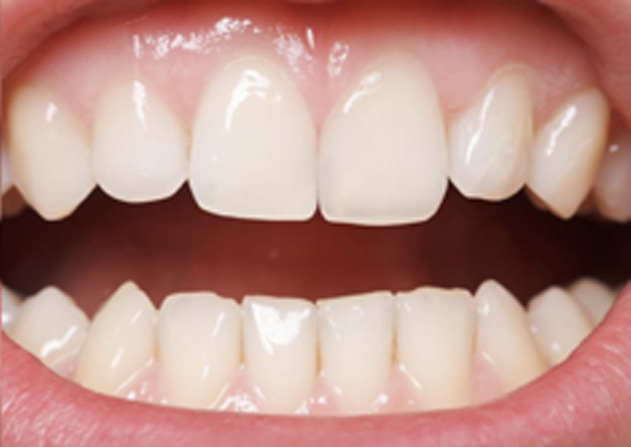 Cosmetic Bonding  - Oswego Dental, Oswego Dentist