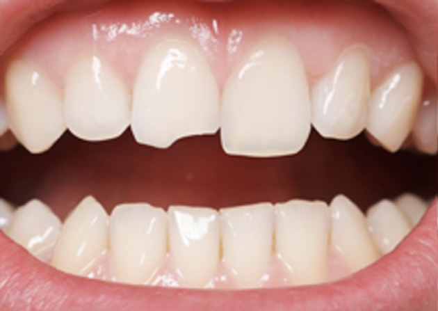 Cosmetic Bonding  - Oswego Dental, Oswego Dentist