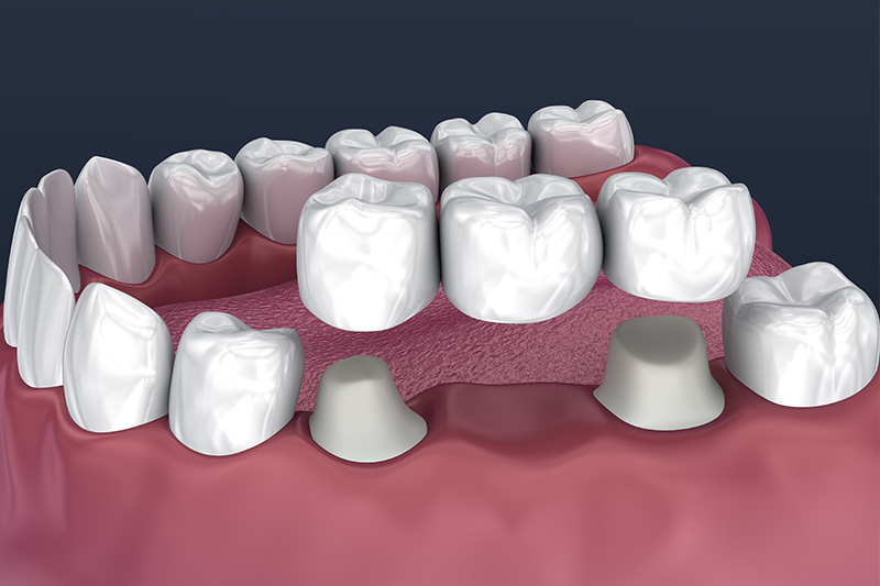 Crowns and Bridges, Inlays and Onlays  - Oswego Dental, Oswego Dentist