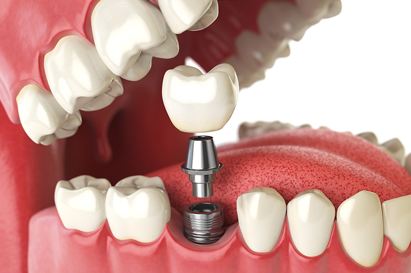 Dental Implants - Oswego Dental, Oswego Dentist