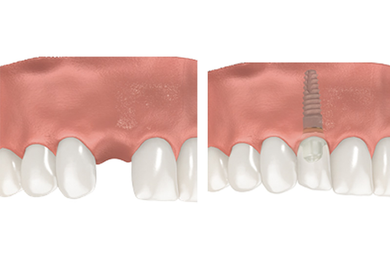 Dental Implants - Oswego Dental, Oswego Dentist