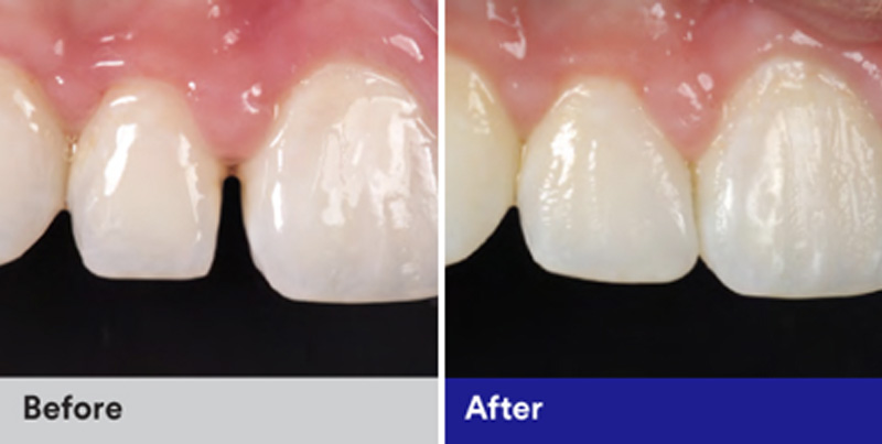 BioClear Diastema Closure and Black Triangle Closure  - Oswego Dental, Oswego Dentist