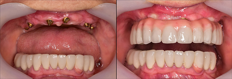 Implant Overdentures and Fixed All-On-X Treatment  - Oswego Dental, Oswego Dentist