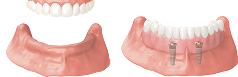 Implant Overdentures and Fixed All-On-X Treatment  - Oswego Dental, Oswego Dentist