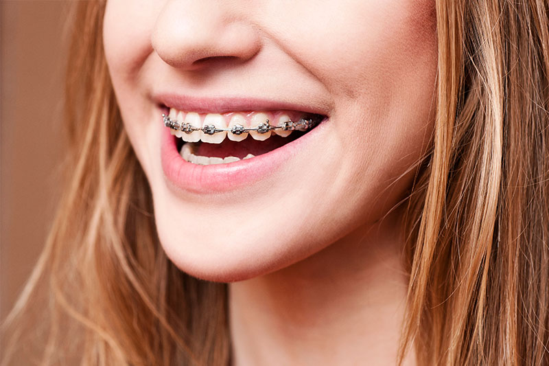 Orthodontics - Oswego Dental, Oswego Dentist