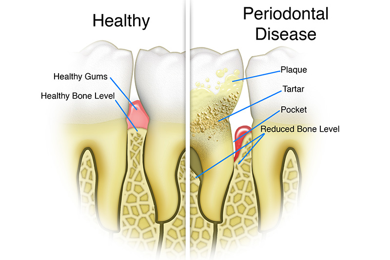 Scaling & Root Planings (Deep Cleanings)  - Oswego Dental, Oswego Dentist