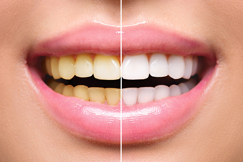 Teeth Whitening - Oswego Dental, Oswego Dentist