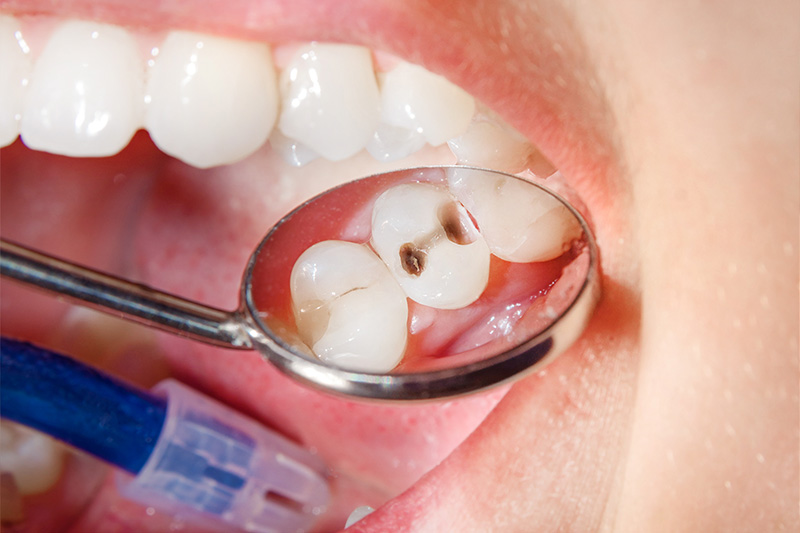 Tooth Colored Composite Fillings  - Oswego Dental, Oswego Dentist
