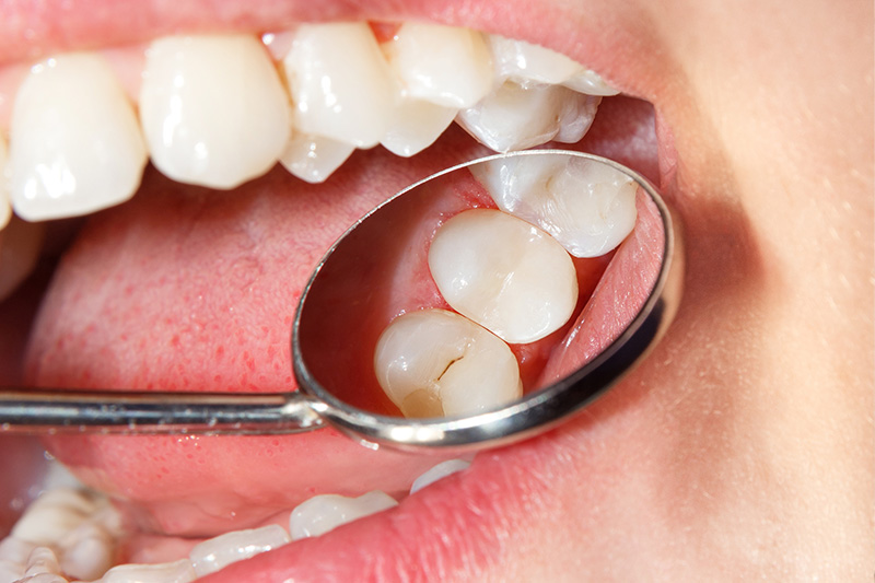 Tooth Colored Composite Fillings  - Oswego Dental, Oswego Dentist