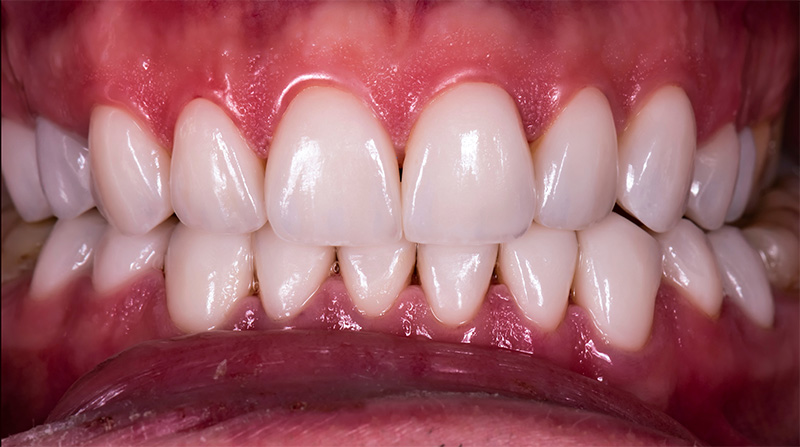Veneers  - Oswego Dental, Oswego Dentist