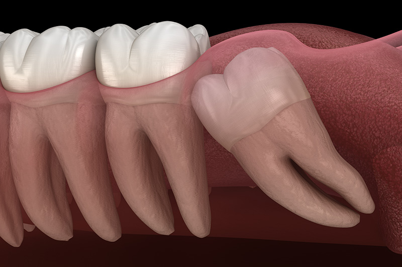 Extracciones de Muelas del Juicio (con Sedante)  - Oswego Dental, Oswego Dentist